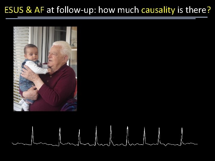 ESUS & AF at follow-up: how much causality is there? 