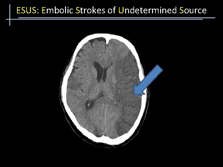 ESUS: Embolic Strokes of Undetermined Source 