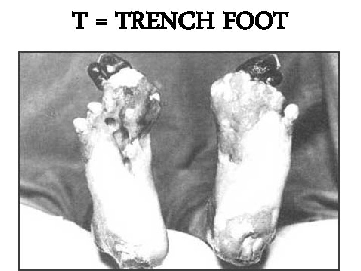 T = TRENCH FOOT 