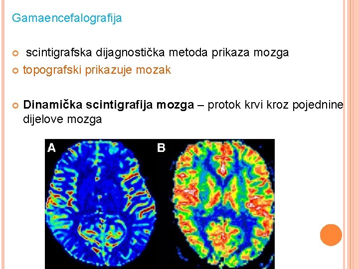 Gamaencefalografija scintigrafska dijagnostička metoda prikaza mozga topografski prikazuje mozak Dinamička scintigrafija mozga – protok
