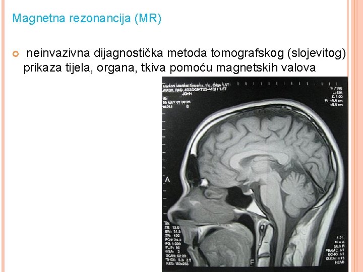 Magnetna rezonancija (MR) neinvazivna dijagnostička metoda tomografskog (slojevitog) prikaza tijela, organa, tkiva pomoću magnetskih Magnetna rezonancija (MR) neinvazivna dijagnostička metoda tomografskog (slojevitog) prikaza tijela, organa, tkiva pomoću magnetskih
