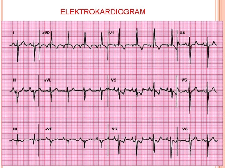 ELEKTROKARDIOGRAM 