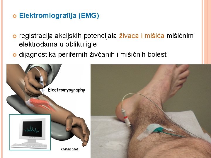  Elektromiografija (EMG) registracija akcijskih potencijala živaca i mišića mišićnim elektrodama u obliku igle