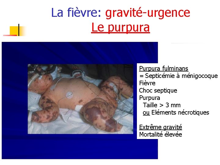 La fièvre: gravité-urgence Le purpura Purpura fulminans = Septicémie à ménigocoque Fièvre Choc septique