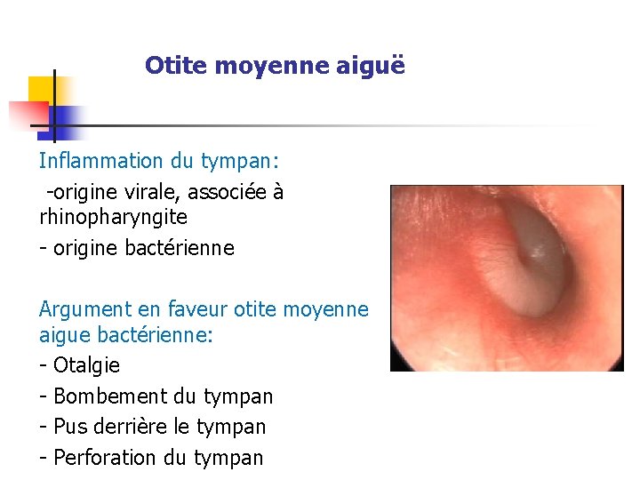 Otite moyenne aiguë Inflammation du tympan: -origine virale, associée à rhinopharyngite - origine bactérienne