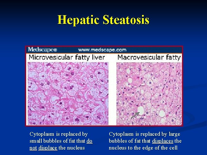 Hepatic Steatosis Cytoplasm is replaced by small bubbles of fat that do not displace