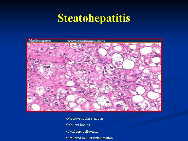 Steatohepatitis • Macrovesicular steatosis • Mallory bodies • Cytologic ballooning • Scattered lobular inflammation