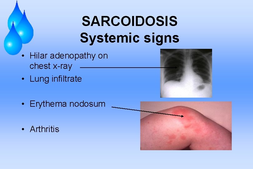 SARCOIDOSIS Systemic signs • Hilar adenopathy on chest x-ray • Lung infiltrate • Erythema