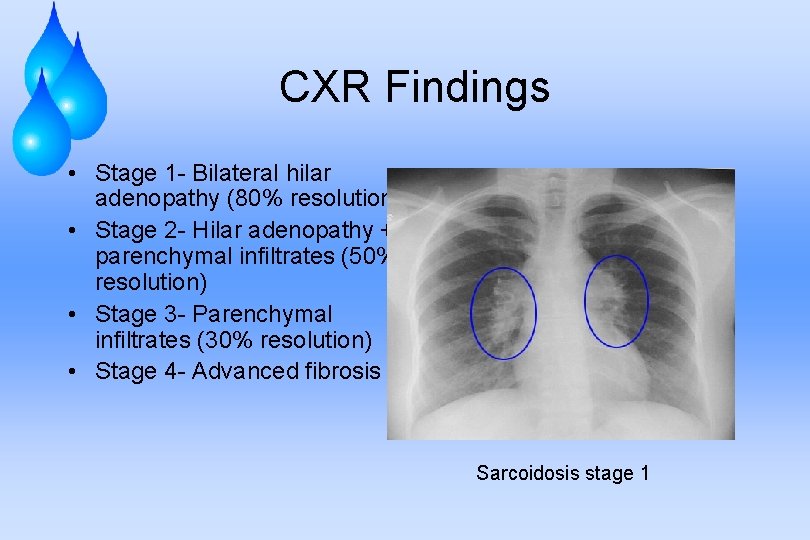CXR Findings • Stage 1 - Bilateral hilar adenopathy (80% resolution) • Stage 2