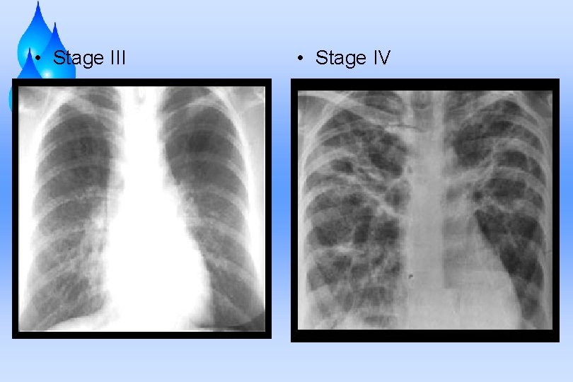  • Stage III • Stage IV 