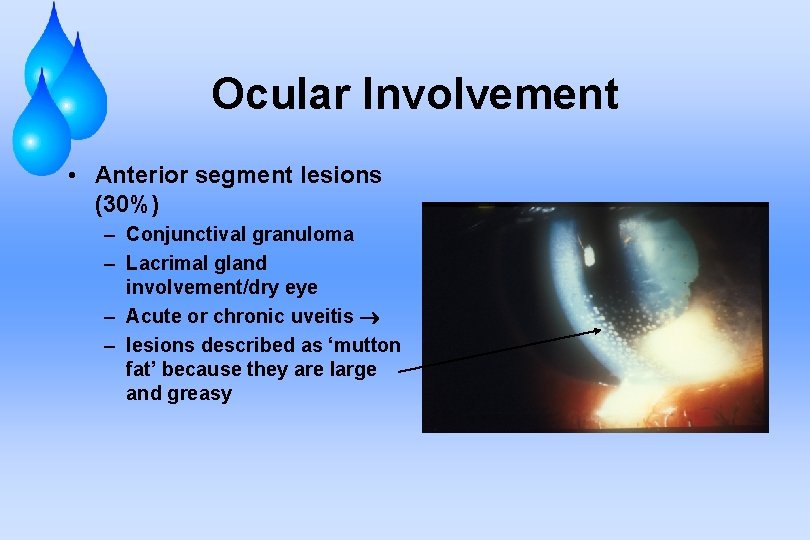Ocular Involvement • Anterior segment lesions (30%) – Conjunctival granuloma – Lacrimal gland involvement/dry