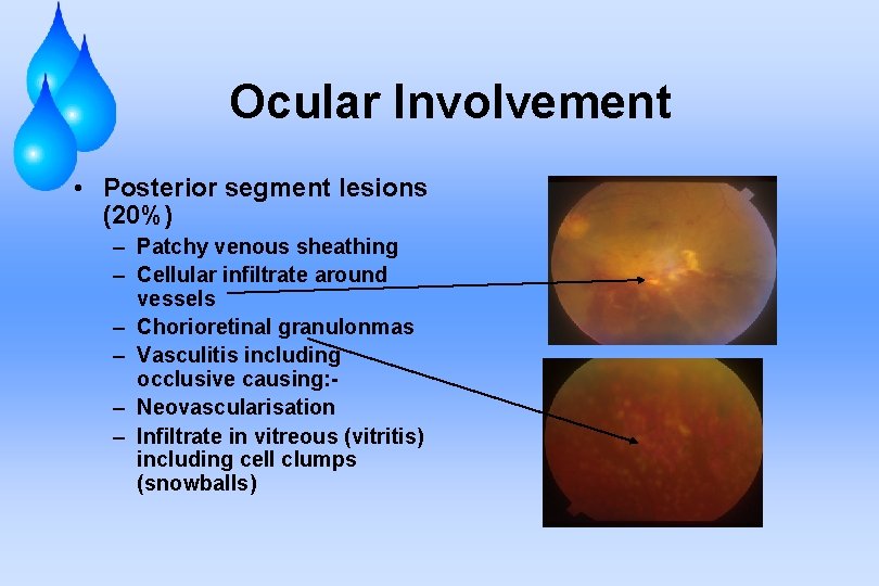 Ocular Involvement • Posterior segment lesions (20%) – Patchy venous sheathing – Cellular infiltrate