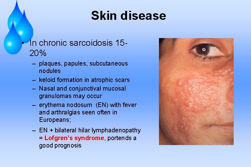 Skin disease • In chronic sarcoidosis 1520% – plaques, papules, subcutaneous nodules – keloid