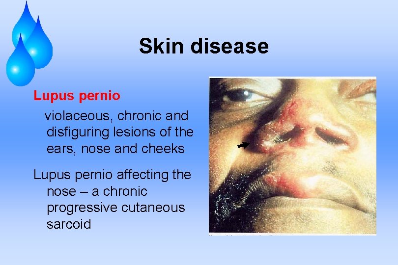 Skin disease Lupus pernio violaceous, chronic and disfiguring lesions of the ears, nose and
