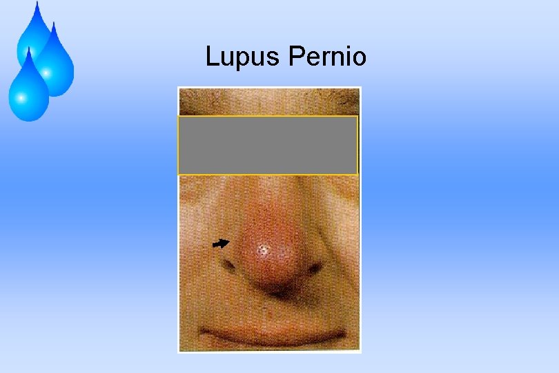 Lupus Pernio 