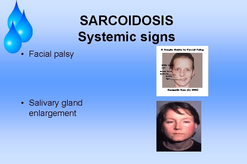 SARCOIDOSIS Systemic signs • Facial palsy • Salivary gland enlargement 