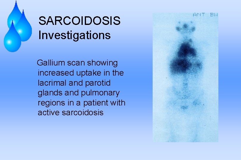 SARCOIDOSIS Investigations Gallium scan showing increased uptake in the lacrimal and parotid glands and