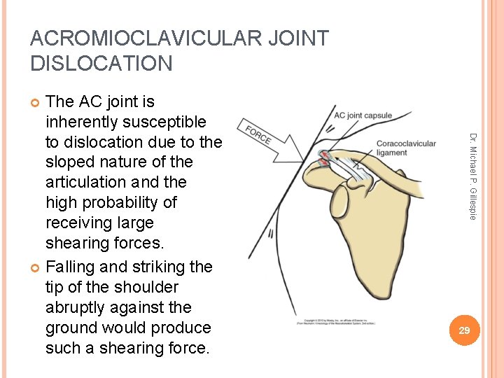 ACROMIOCLAVICULAR JOINT DISLOCATION The AC joint is inherently susceptible to dislocation due to the