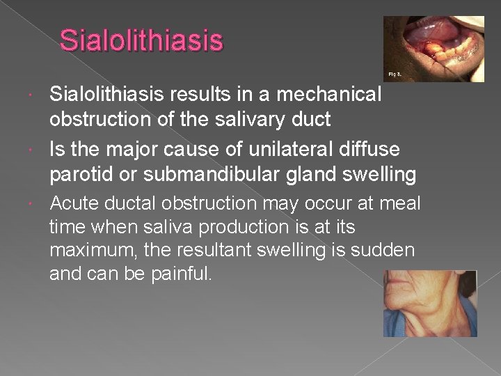 Sialolithiasis results in a mechanical obstruction of the salivary duct Is the major cause Sialolithiasis results in a mechanical obstruction of the salivary duct Is the major cause