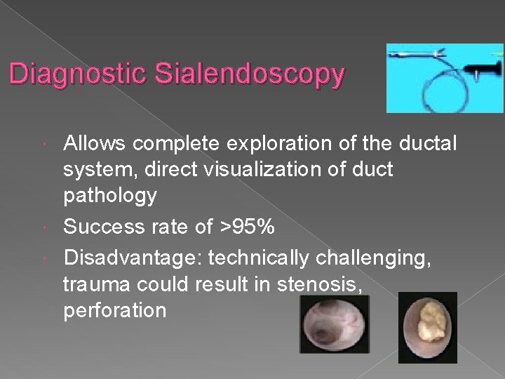 Diagnostic Sialendoscopy Allows complete exploration of the ductal system, direct visualization of duct pathology Diagnostic Sialendoscopy Allows complete exploration of the ductal system, direct visualization of duct pathology