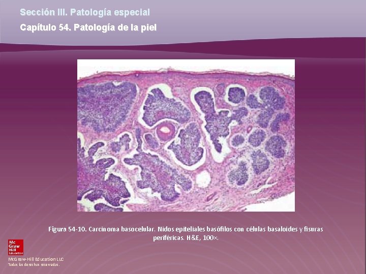 Sección III. Patología especial Capítulo 54. Patología de la piel Figura 54 -10. Carcinoma