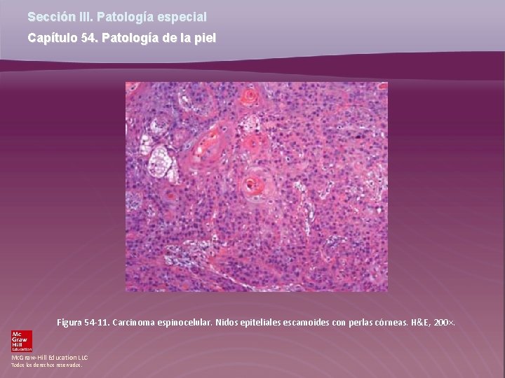 Sección III. Patología especial Capítulo 54. Patología de la piel Figura 54 -11. Carcinoma