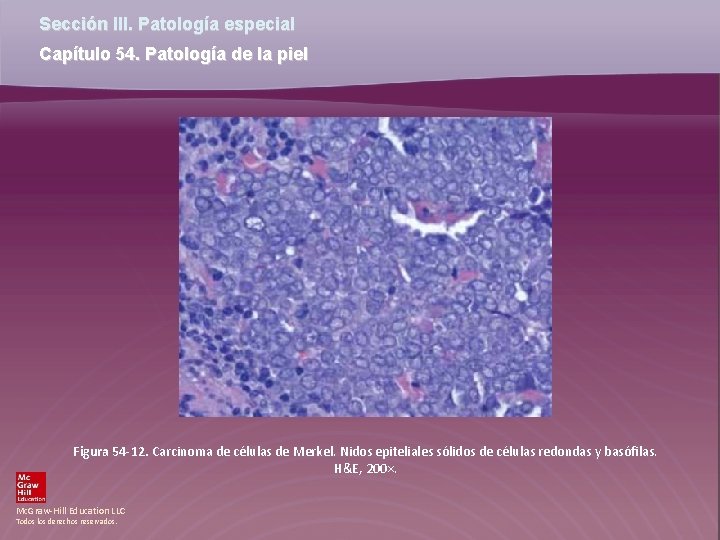 Sección III. Patología especial Capítulo 54. Patología de la piel Figura 54 -12. Carcinoma