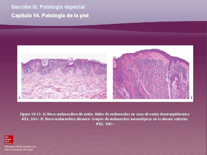 Sección III. Patología especial Capítulo 54. Patología de la piel Figura 54 -13. A)