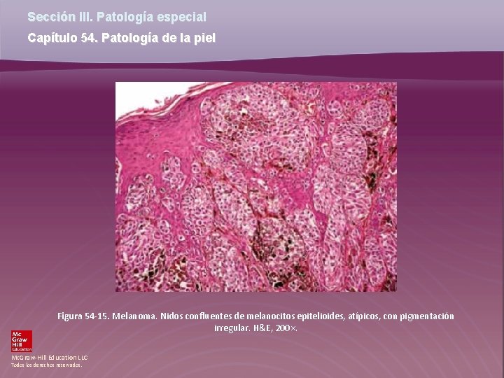 Sección III. Patología especial Capítulo 54. Patología de la piel Figura 54 -15. Melanoma.