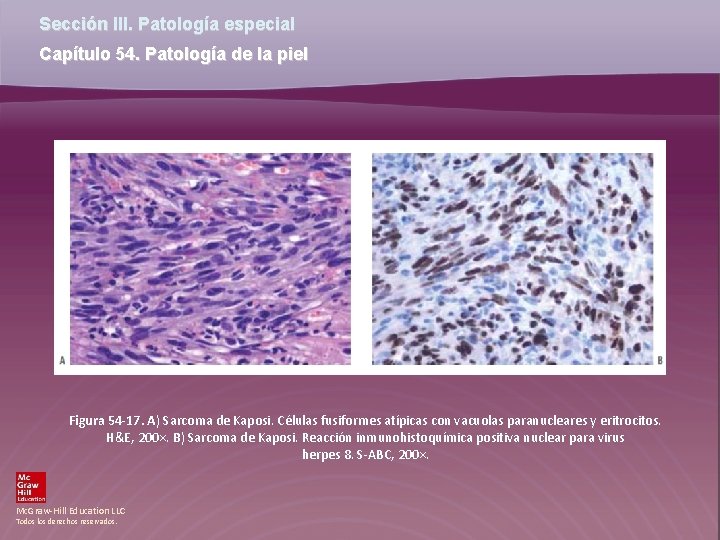 Sección III. Patología especial Capítulo 54. Patología de la piel Figura 54 -17. A)