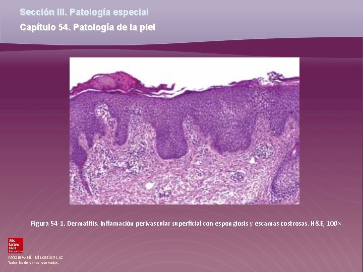 Sección III. Patología especial Capítulo 54. Patología de la piel Figura 54 -1. Dermatitis.