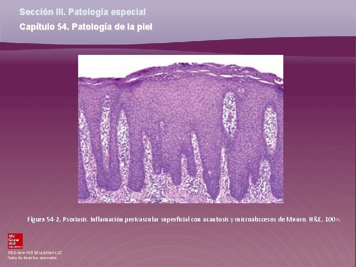 Sección III. Patología especial Capítulo 54. Patología de la piel Figura 54 -2. Psoriasis.