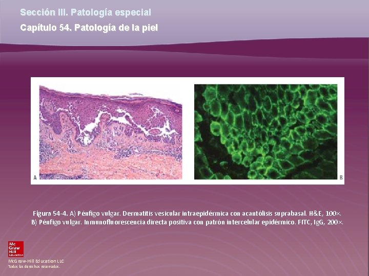 Sección III. Patología especial Capítulo 54. Patología de la piel Figura 54 -4. A)