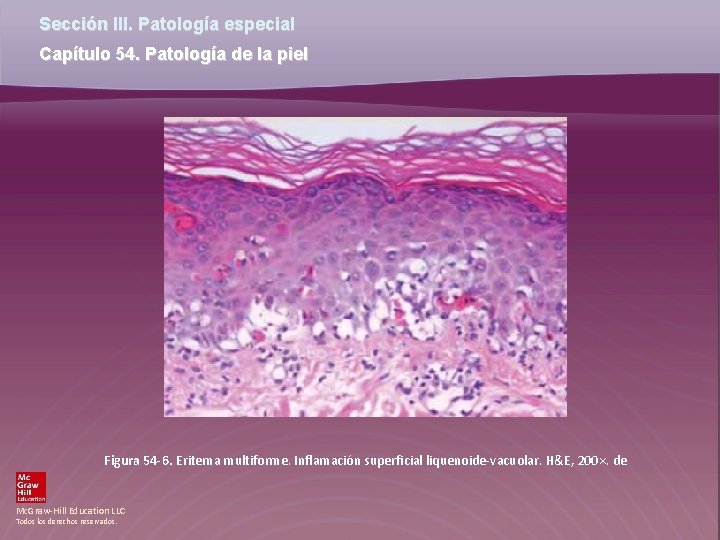 Sección III. Patología especial Capítulo 54. Patología de la piel Figura 54 -6. Eritema