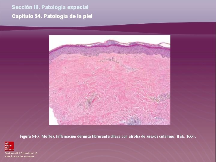 Sección III. Patología especial Capítulo 54. Patología de la piel Figura 54 -7. Morfea.