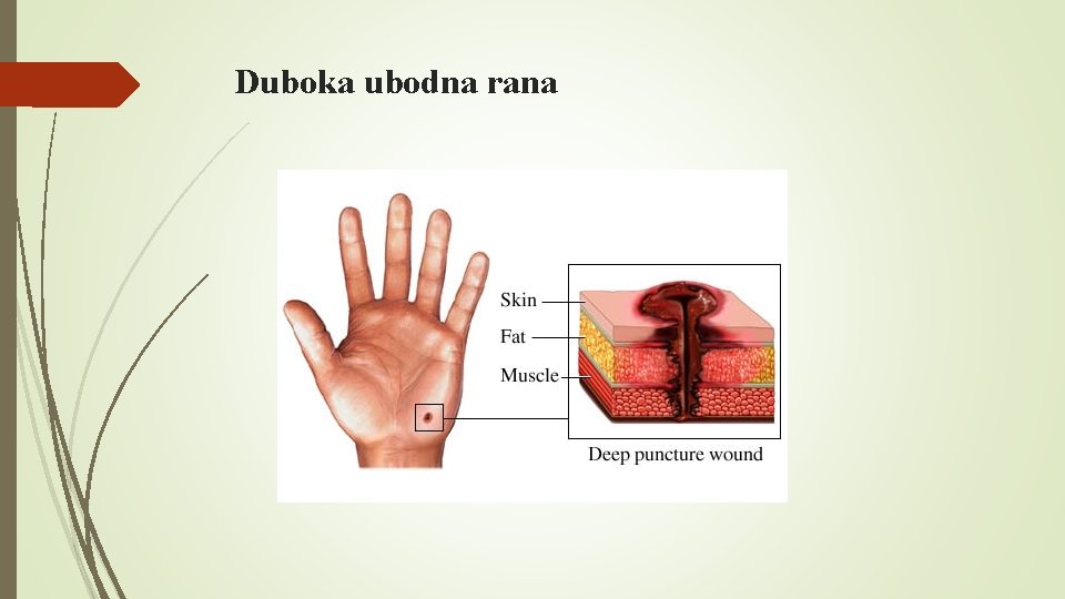 Duboka ubodna rana 