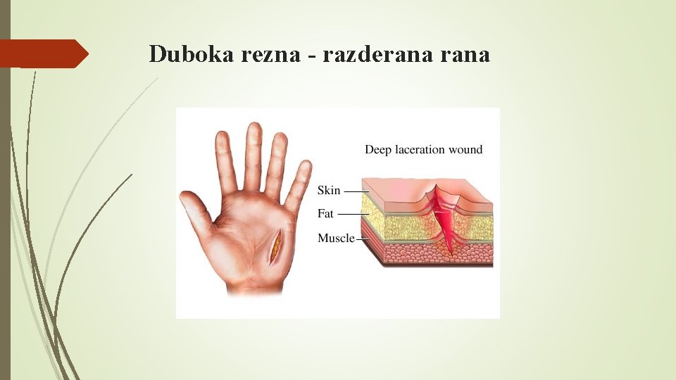 Duboka rezna - razderana 