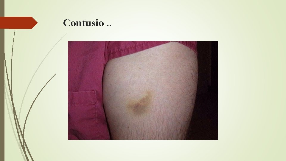 Contusio. . Contusio. .
