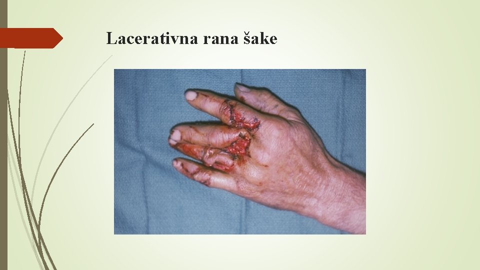 Lacerativna rana šake 