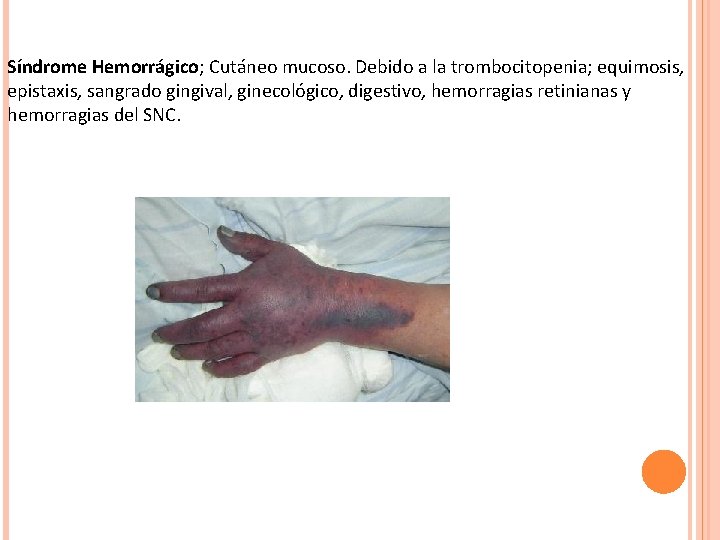 Síndrome Hemorrágico; Cutáneo mucoso. Debido a la trombocitopenia; equimosis, epistaxis, sangrado gingival, ginecológico, digestivo,