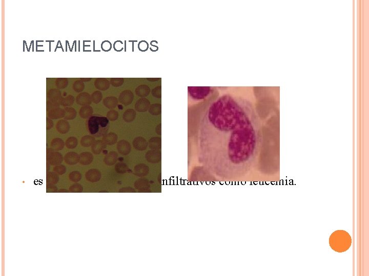 METAMIELOCITOS • es indicativa de procesos infiltrativos como leucemia. 