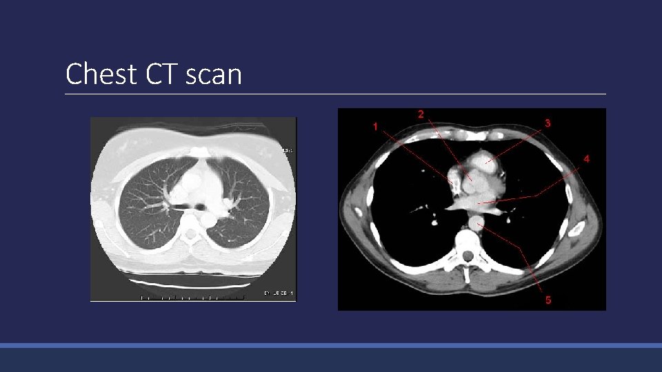 Chest CT scan 