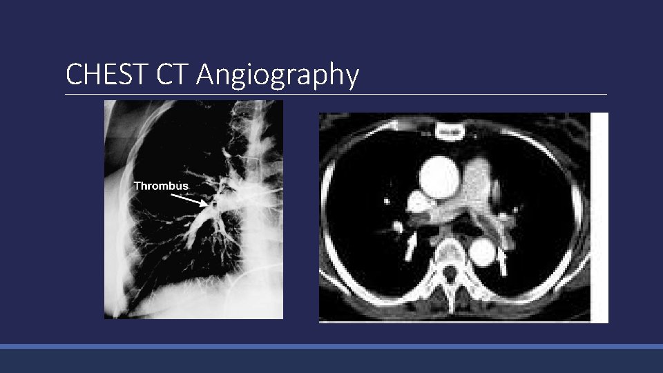 CHEST CT Angiography 