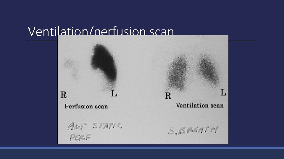 Ventilation/perfusion scan 