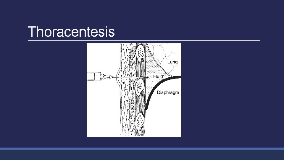 Thoracentesis 