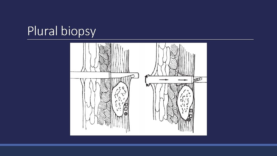 Plural biopsy 