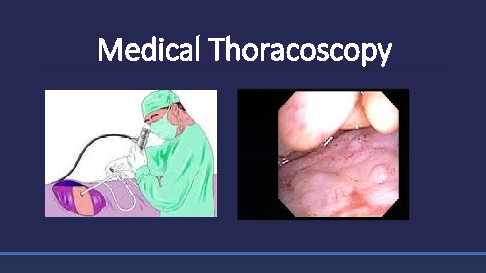 Medical Thoracoscopy 