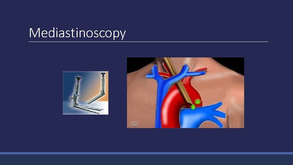 Mediastinoscopy 