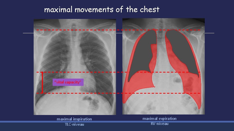 maximal movements of the chest “vital capacity” maximal inspiration TLC-niveau maximal expiration RV-niveau 