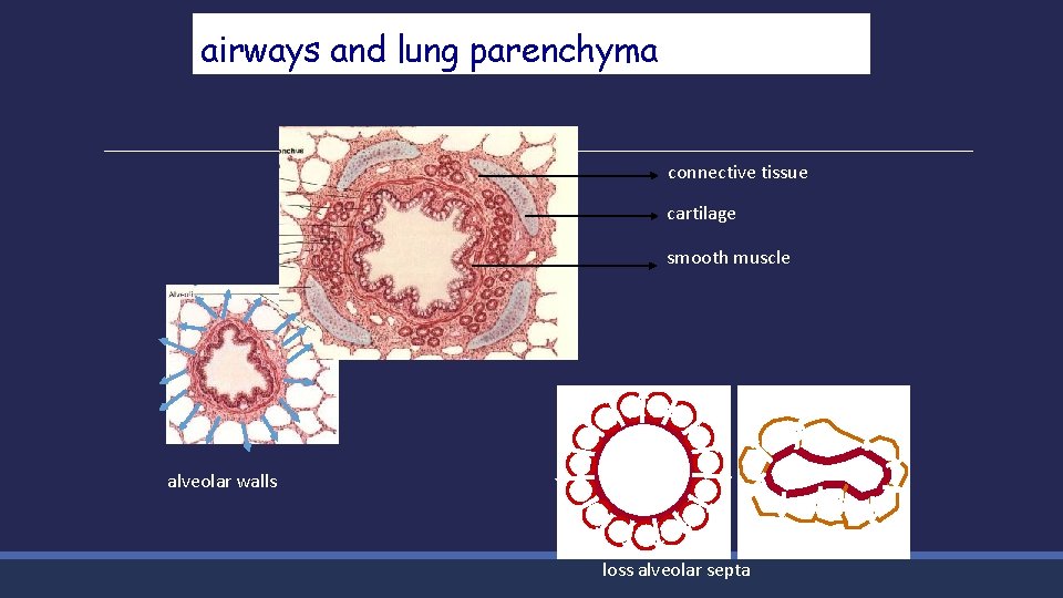 airways and lung parenchyma connective tissue cartilage smooth muscle alveolar walls loss alveolar septa